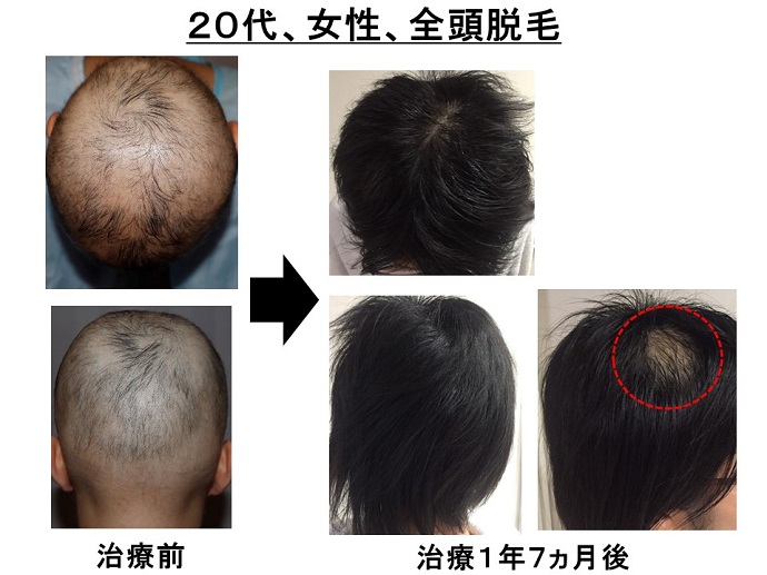 円形脱毛症　病院